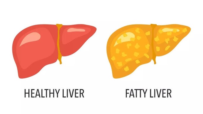 fatty liver diet plan